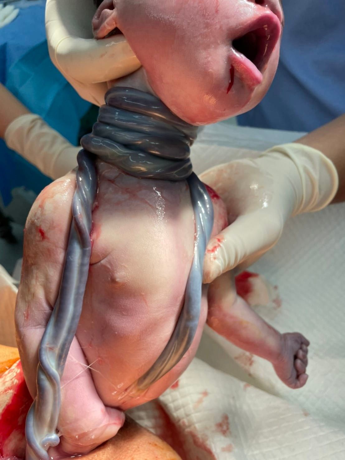 ▲林思宏醫師分享一名嬰兒臍帶繞頸5圈畫面，引發討論。（圖／翻攝自Facebook／林思宏醫師）