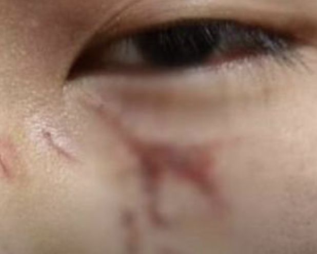▲15歲男生被老師暴打，臉部縫了16針。（圖／翻攝自沸點新聞）