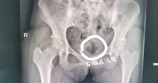 情侶為了尋求刺激，竟將異物塞進下體。（圖／翻攝自錢江晚報，下同）