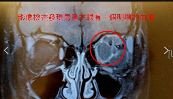 ▲男童左眼有淋巴腫瘤被水槍射傷。（圖／彰化基督教醫院提供）