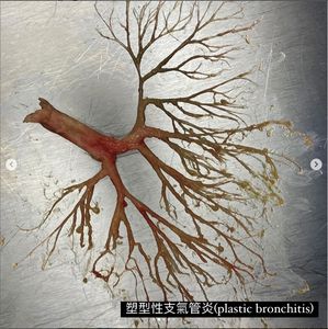 50歲男呼吸衰竭「咳出一根人蔘」！震撼照曝　網驚：恐怖蠟像館