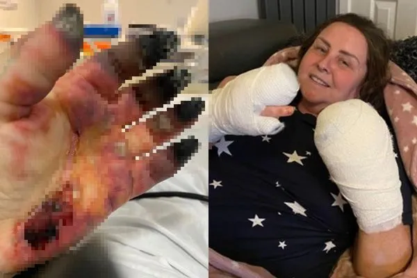 ▲▼她確診後手腳「發黑凍傷」截肢保命。（圖／翻攝自JustGiving）