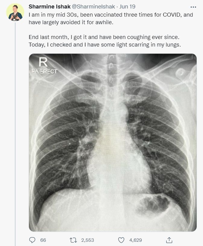 ▲▼馬來西亞網友確診後不斷咳嗽，肺部X光照看見傷疤。（圖／翻攝推特@SharmineIshak）