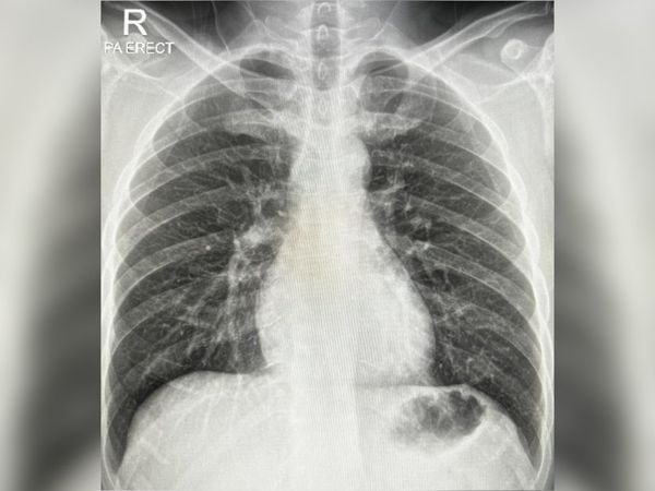 ▲▼馬來西亞網友確診後不斷咳嗽，肺部X光照看見傷疤。（圖／翻攝推特@SharmineIshak）