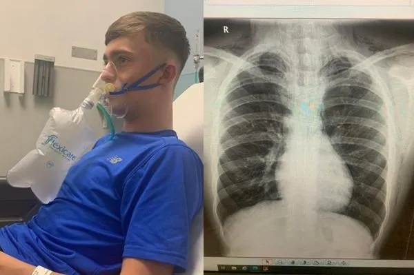 16歲男吸食笑氣「肺部突然爆裂」　媽嚇壞：摸起來像被破掉泡綿。（圖／翻攝自Facebook／Cathy McCann）