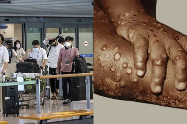▲▼猴痘,入境。（圖／達志影像、CFP）