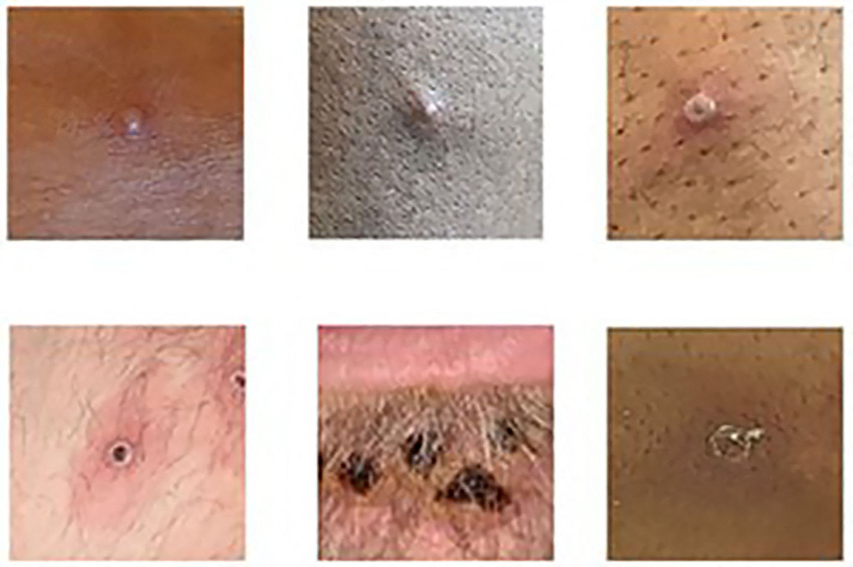 ▲▼英國衛生安全局發佈一張圖片，展示了一組猴痘皮疹病變的拼貼圖。（圖／CFP）