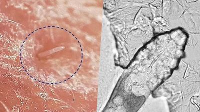 「八腳蠕形蟎蟲」在你臉上交配！專家研究：幾乎人人毛孔裡都有，但牠們不壞