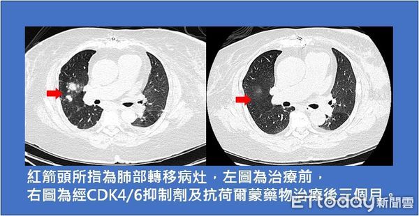 ▲左圖為治療前，右圖為經標靶藥物（CDK4/6抑制劑）加上荷爾蒙抑制藥物治療後情形。（圖／台東馬偕醫院提供，下同）