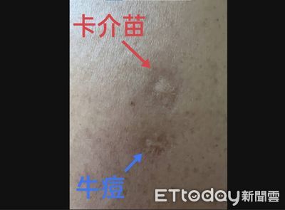誰有猴痘抗體? 醫師教兩招「看身上疤痕或年紀」