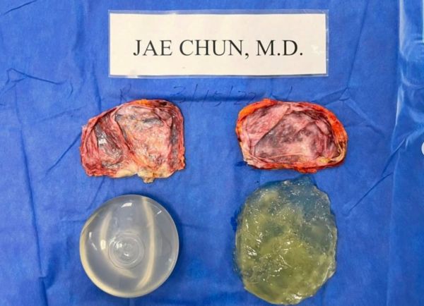 ▲▼整形外科醫師Jae Chun也經常在IG分享取出乳房植入物的手術案例。圖為已植入18年的肌肉下矽膠植入物完整摘除照，儘管單側破裂但並未滲出莢膜。（圖／翻攝自Instagram／jchunmd1）