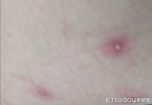 ▲▼台南市出現國內首例猴痘個案，男子的大腿冒出數顆水疱。（圖／台南市衛生局提供）