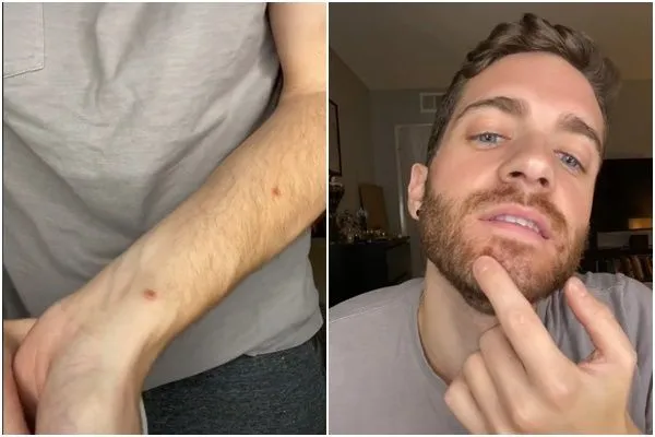 ▲美國男子福特感染猴痘後現身說法。（圖／翻攝TikTok@jmatthiasford）