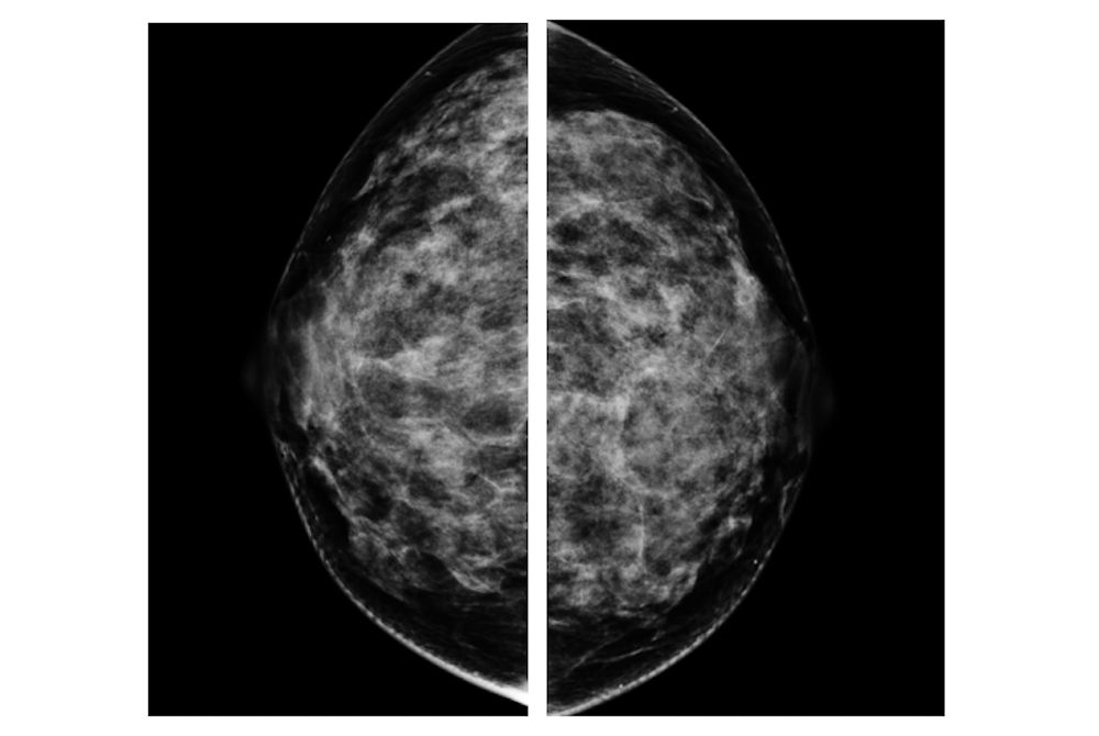 ▲亞洲女性對乳房X光攝影敏感度較低，案1-1、1-2。（圖／問8線上健康諮詢授權提供）