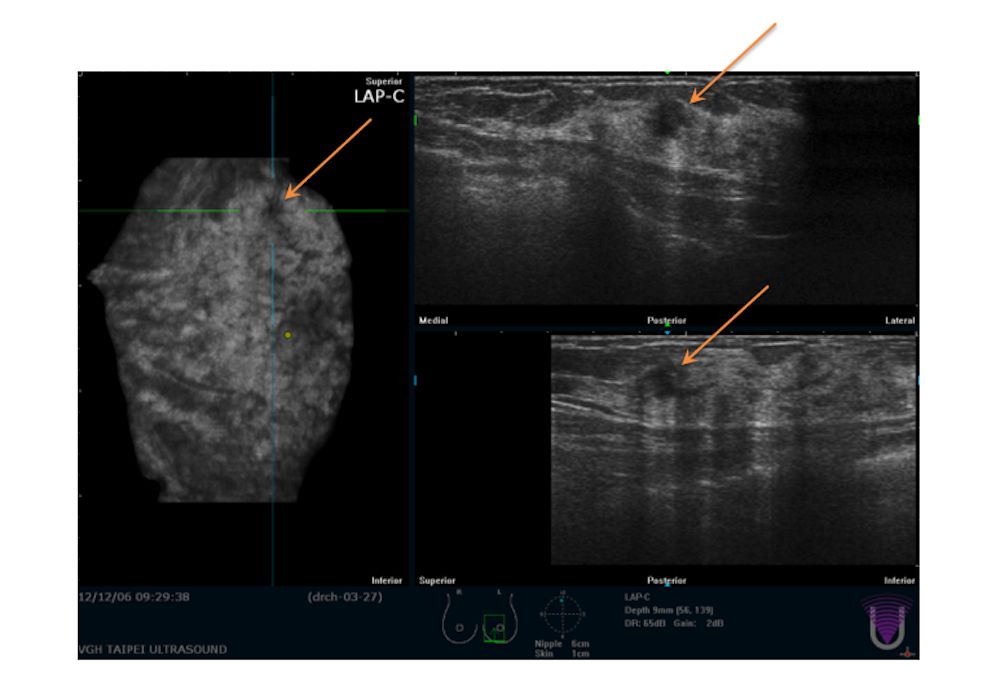 ▲亞洲女性對乳房X光攝影敏感度較低，案1-1、1-2。（圖／問8線上健康諮詢授權提供）