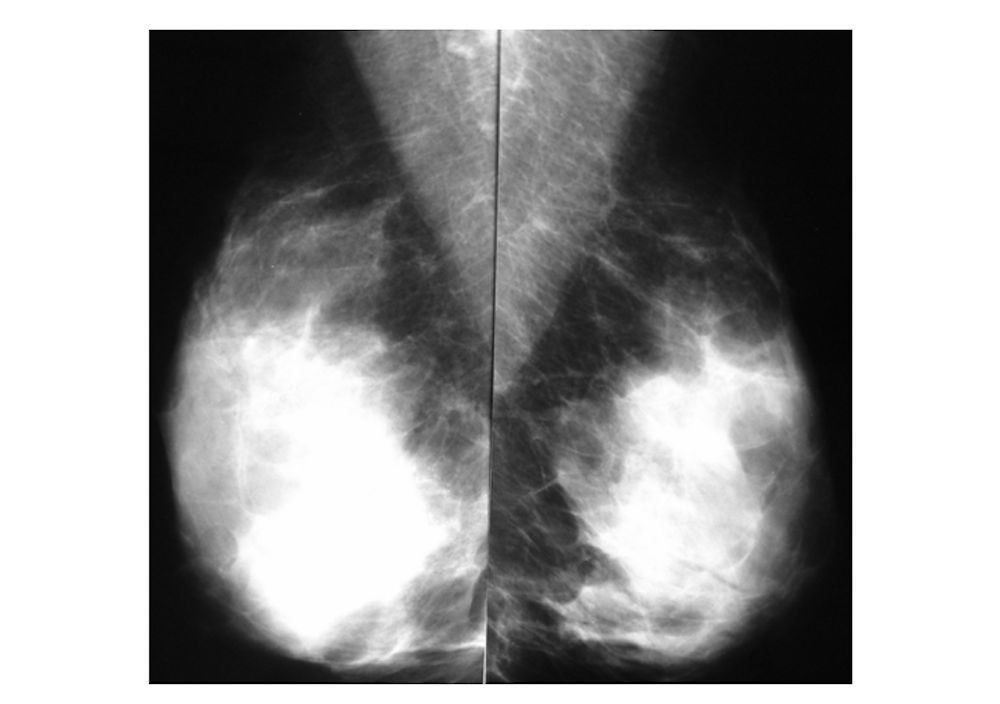 ▲亞洲女性對乳房X光攝影敏感度較低，案2-1、2-2。（圖／問8線上健康諮詢授權提供）