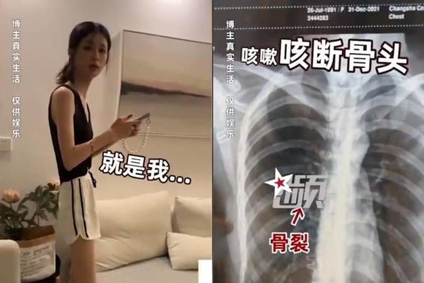 湖南一名女子身高175公分體重僅46公斤，一度因為咳嗽咳到肋骨斷掉。（翻攝自微博）