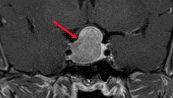 ▲▼術前腦部核磁共振影像之正面切面，紅色箭頭處為腦下垂體腫瘤之位置。（圖／馬偕醫院提供）