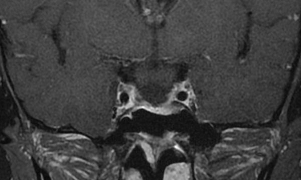 ▲▼術後腦部核磁共振影像之正面切面，顯示腦下垂體腫瘤已完整移除。（圖／馬偕醫院提供）