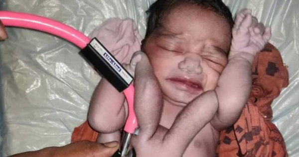 印度一名婦人生下有4手4腳的嬰兒。（圖／翻攝自@smallpawsdk推特，下同）