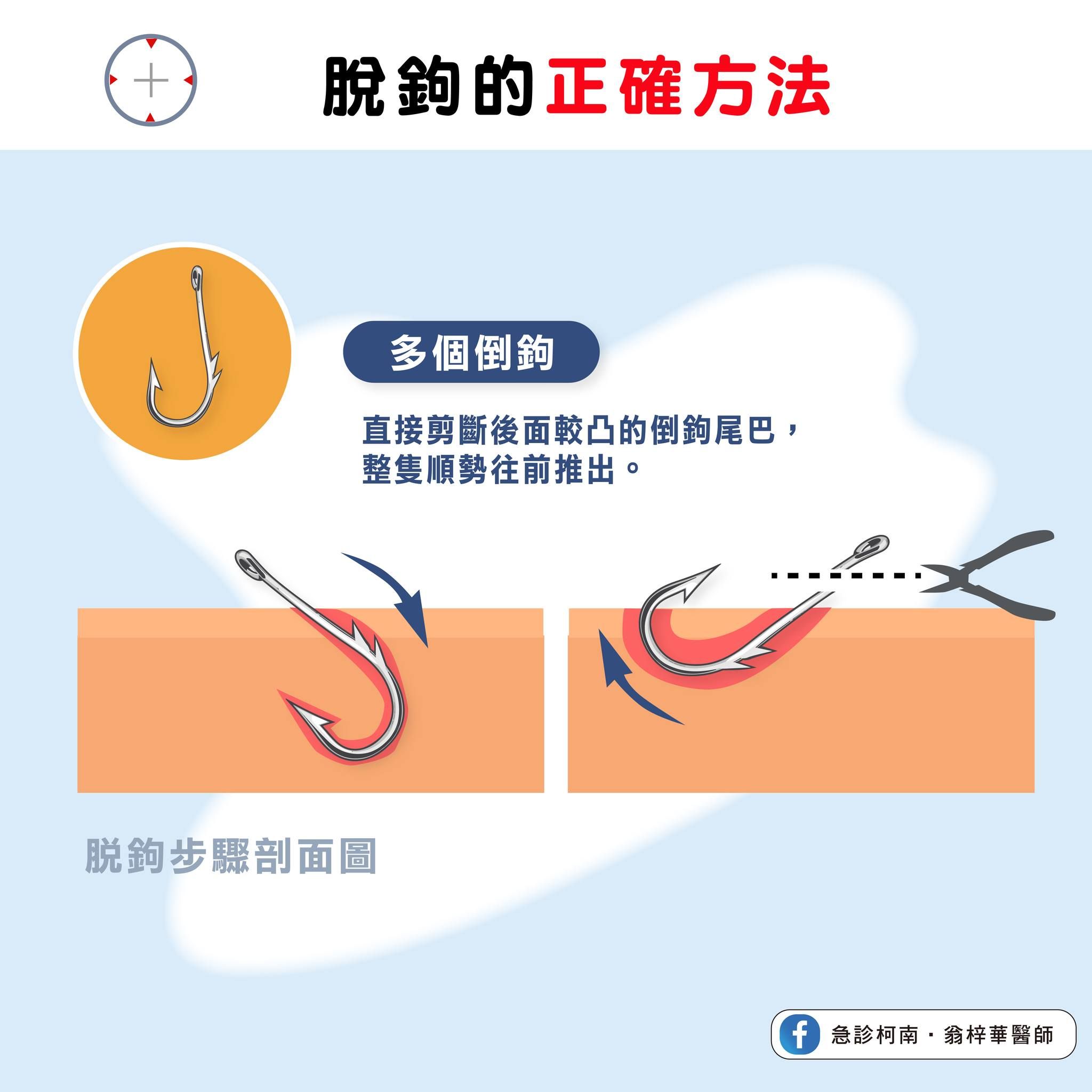 ▲被魚鉤勾到千萬別亂拔。（圖／翁梓華授權提供）