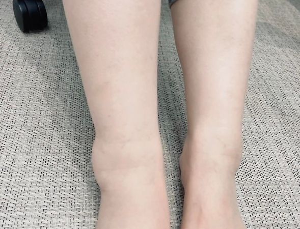 ▲盧秀燕PO出照片，右腳明顯腫脹。（圖／翻攝自Facebook／盧秀燕）