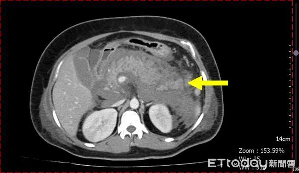 ▲40歲婦連吐2天，一查三酸甘油酯竟超標53倍險急性胰臟炎喪命。（圖／中港澄清醫院提供）
