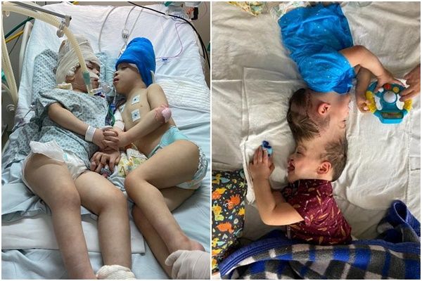 ▲▼巴西連體嬰貝爾納多（Bernardo Lima）及亞瑟（Arthur Lima）成功分離。（圖／路透）