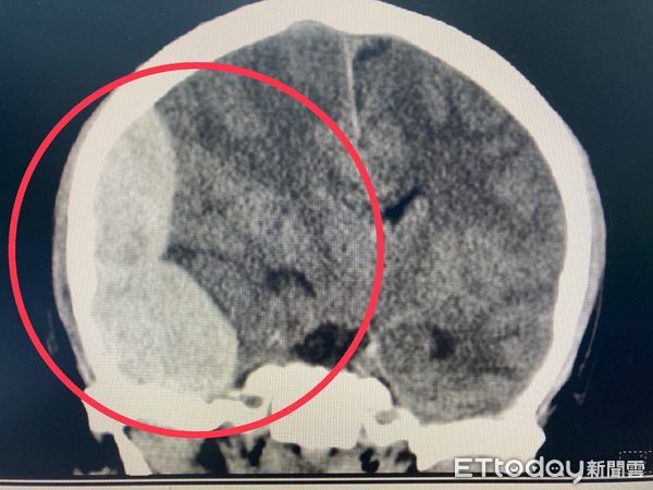 ▲▼紅圈處為患者腦出血的電腦斷層影像照。（圖／衛福部南投醫院提供）