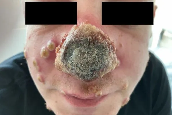 ▲▼德國一名40歲男子趕染猴痘，鼻子壞死。（圖／翻攝link.springer.com）