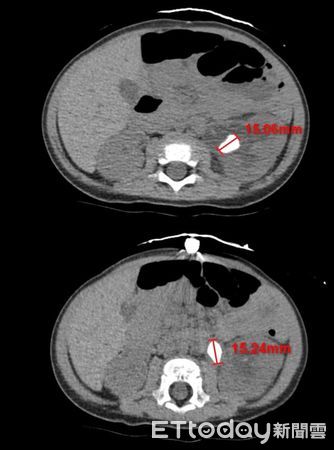 ▲電腦斷層不同切面顯示，余小弟體內有兩顆約1.5公分大的結石。（圖／慈濟醫學中心提供，下同）