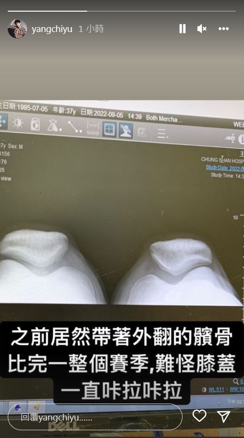 ▲小煜發現膝蓋髕骨外翻。（圖／翻攝自Instagram／yangchiyu）