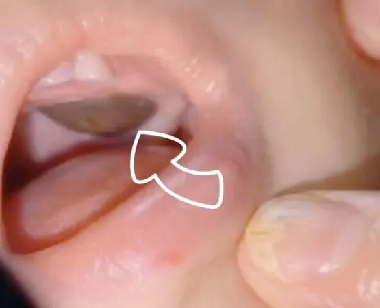 ▲▼幼童嘴長「腫瘤」被要求開刀！換醫院後「棉花棒一戳」竟沒事了。（圖／翻攝微博）