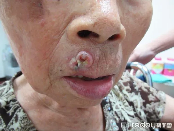 ▲▼南投一名阿嬤因嘴角長痘痘相當困擾，接受檢查後才發現，竟是惡性腫瘤。（圖／南投醫院提供）