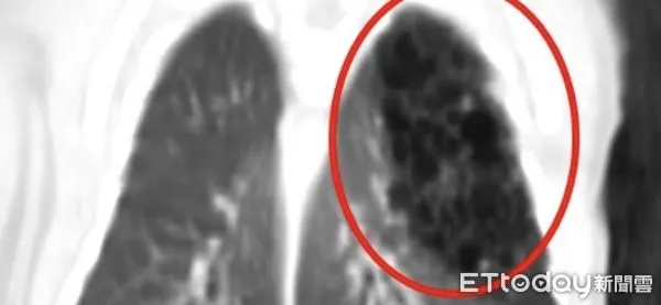▲電腦斷層影像顯示，小敬的左上肺葉被類似囊泡樣的組織取代。（圖／慈濟醫學中心提供，下同）