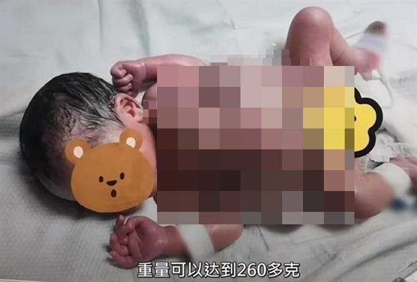 ▲▼深圳男嬰出生就有「4手4腳2生殖器」　醫判定「寄生胎」緊急手術。（圖／翻攝微博）