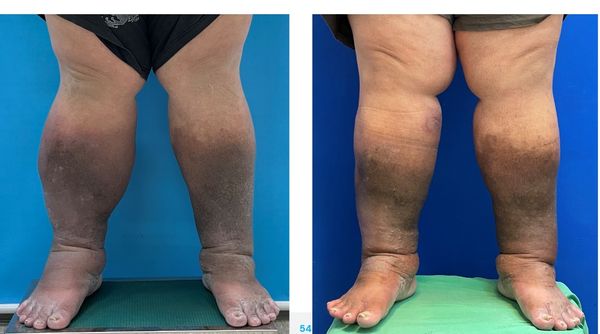 ▲小維術前右腳最為腫脹(圖左)，右腳先接受手術後，腿圍減少10公分(圖右)。（圖／張智豪醫師提供）