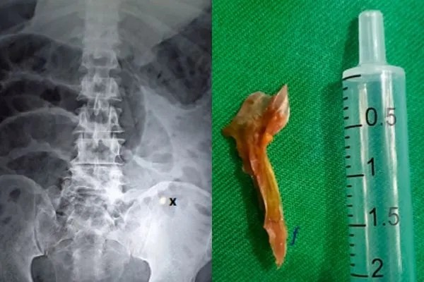 ▲▼男子被魚骨刺穿小腸引發嚴重感染身亡。（圖／翻攝自International Journal of Surgery Case Reports）