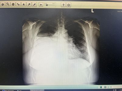 單親媽確診…逐漸喘不過氣！醫驚見「右下肺全白」　心碎真相惹哭網