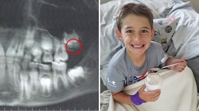 9歲帥弟「勇敢拔智齒」成最小就拔世界紀錄　燦笑對鏡頭吃優格