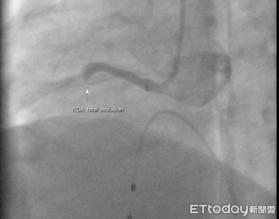 ▲命大！貨車司機心肌梗塞還硬上路飆100多公里回台中就醫，醫生搖頭。（圖／院方提供）
