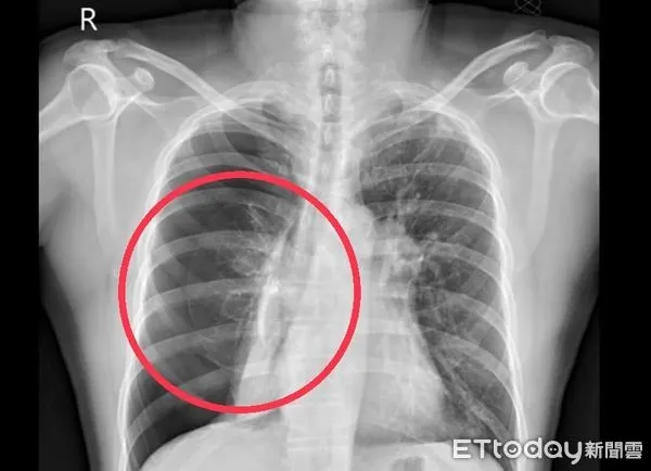 ▲X光片的紅圈處顯示患者右肺明顯塌陷。（圖／衛福部南投醫院提供）