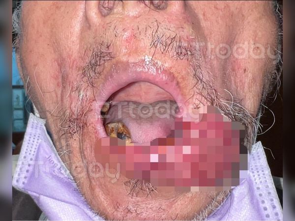 ▲高雄阿公罹下唇癌，拖了3年腫瘤增大，如8公分的香腸掛在嘴邊。（圖／王建忠醫師提供）