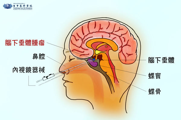 腦下垂體腫瘤。（圖／台中慈濟醫院提供）