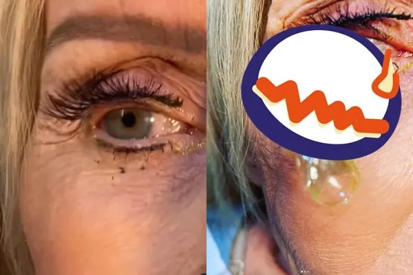 ▲▼她眼睛取出「23片」隱形眼鏡。（圖／翻攝自IG／california_eye_associates）