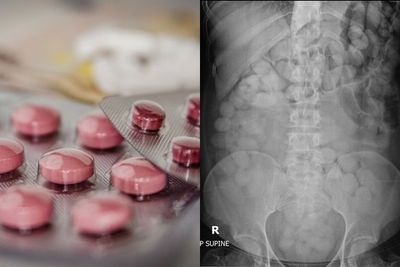 「人體運毒」他硬吞209包搖頭丸！毒袋破掉...瞬間吸收暴斃