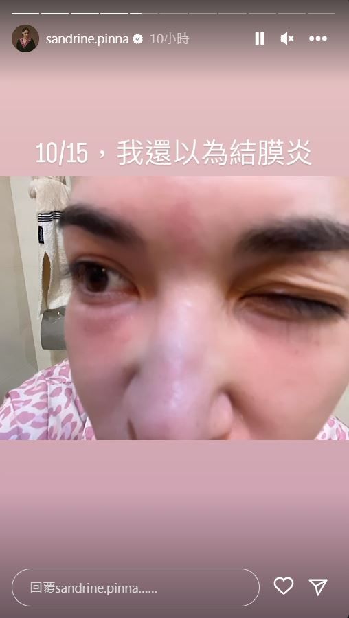 ▲張榕容15日開始臉部出現紅腫。（圖／翻攝自Instagram／sandrine.pinna）
