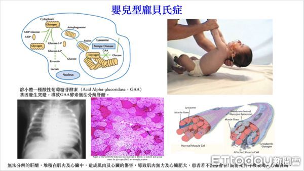 ▲▼龐貝氏症（Pompe disease）。（圖／台北榮總提供）