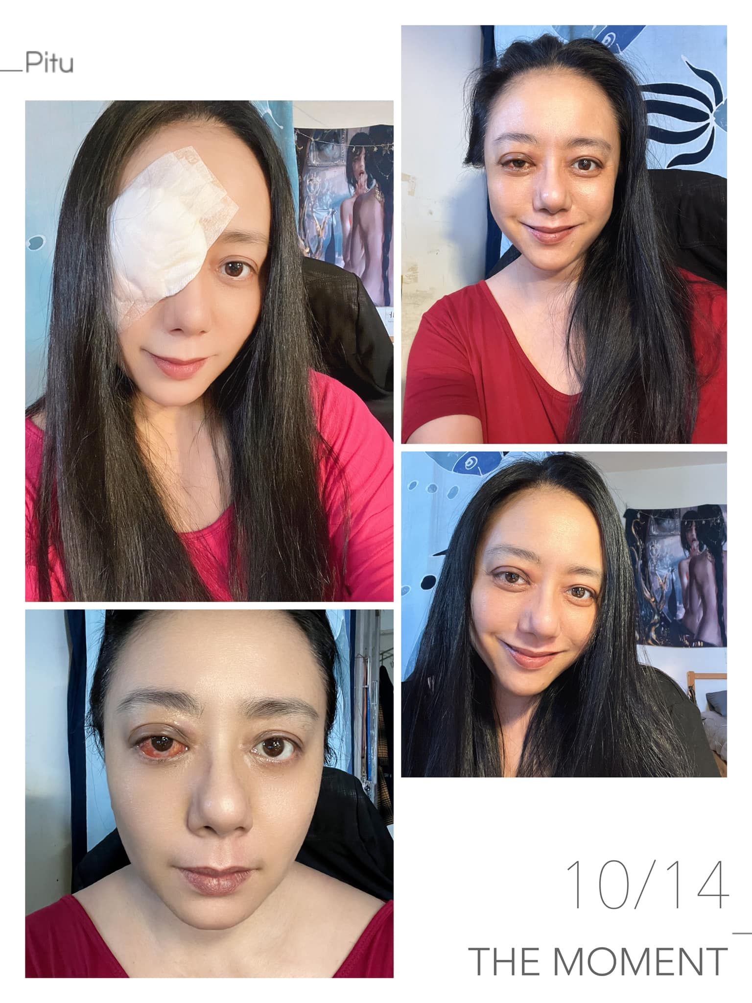 ▲▼高慧君罹怪病1年曝術後照　「腫眼滲血絲」感慨：珍惜重見的美好。（圖／翻攝自Facebook／高慧君 Tanivu Yatauyungana）