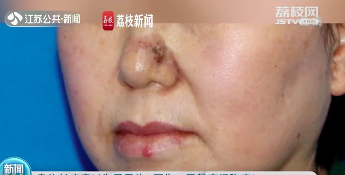 ▲▼黑頭粉刺竟是癌症。（圖／翻攝自荔枝新聞）